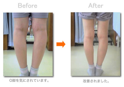 O脚矯正の例